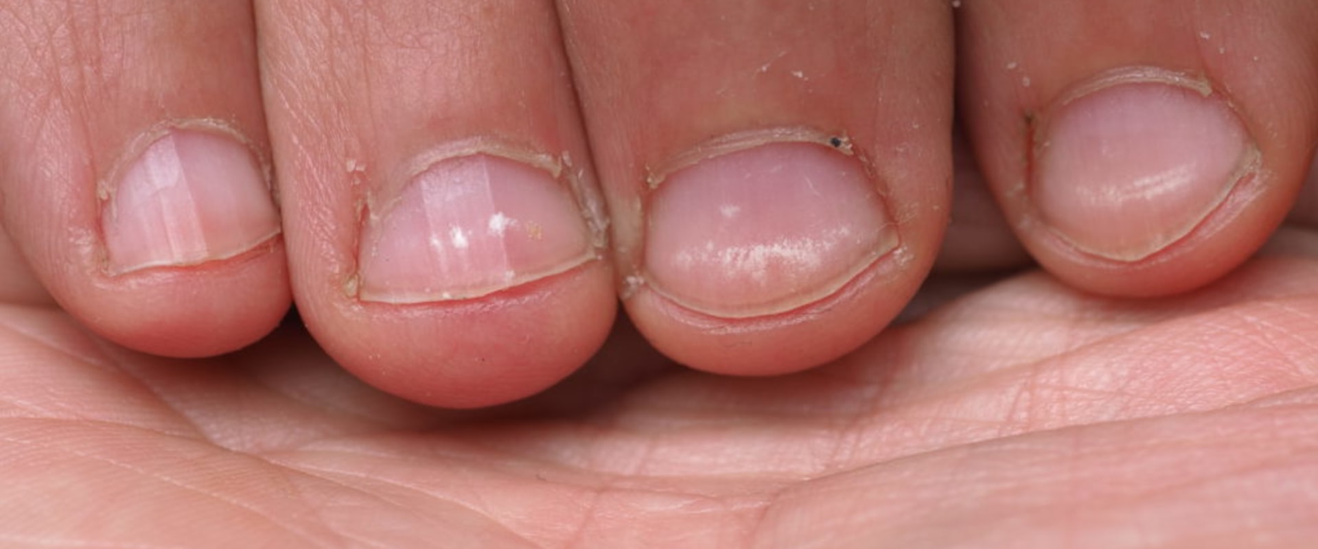 Understanding and Treating White Spots on the Toenail