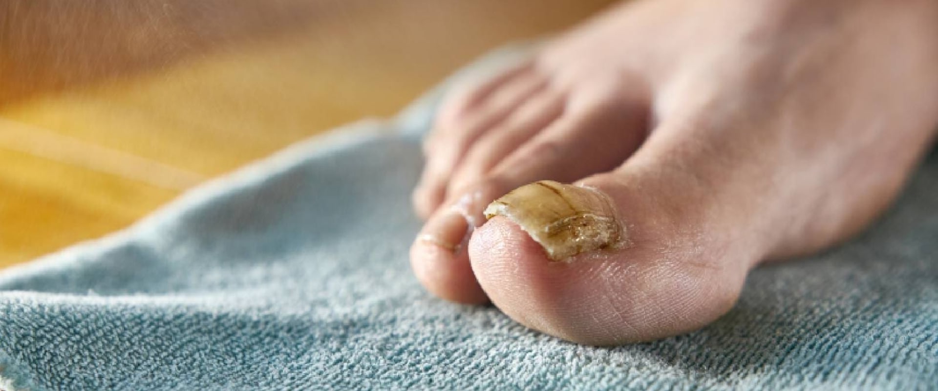 Exploring the Benefits of Apple Cider Vinegar Soak for Toenail Fungus