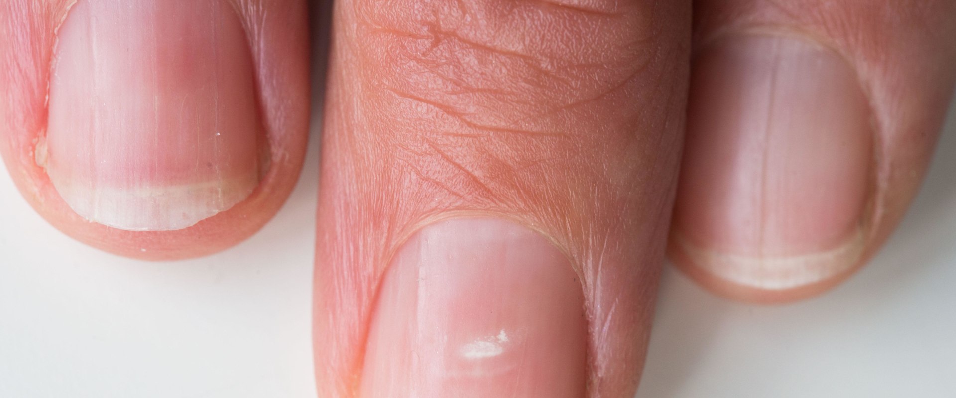 Understanding Loosening and Separation of the Nail from the Nail Bed
