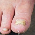 Coconut Oil for Toenail Fungus: Natural Treatment and Prevention