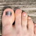 The Truth About Toenail Fungus: Causes, Treatments, and Prevention