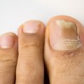 Understanding Laser Treatment for Toenail Fungus