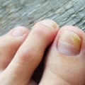 Oral Antifungal Medications for Toenail Fungus: What You Need to Know