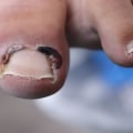 What worsens toenail fungus?