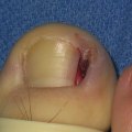 Nail Avulsion with Matrixectomy Treatment: Understanding Toenail Fungus Solutions