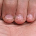 Understanding and Treating White Spots on the Toenail
