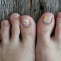 Top 10 Tips for Healthy Feet: Preventing Toenail Fungus