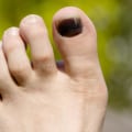 Darkening of the Toenail: Causes, Treatments, and Prevention