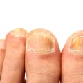Understanding Yeast Infection and Its Effects on Toenails