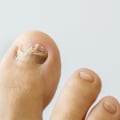 Does hydrogen peroxide help toenail fungus?