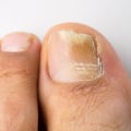 What gut bacteria causes toenail fungus?