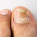 What gut bacteria causes toenail fungus?