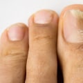Understanding Contact with Infected Persons: How to Prevent and Treat Toenail Fungus