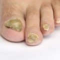 What is the most powerful toenail fungus treatment?