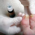 Understanding Yellowing of the Toenail