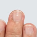 White or Yellow Patches Underneath the Nail: Causes, Treatments, and Prevention Tips