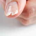 Understanding Brittle and Crumbly Nails: Causes, Treatments, and Prevention Tips