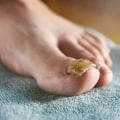 Exploring the Benefits of Apple Cider Vinegar Soak for Toenail Fungus