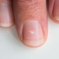 Understanding Loosening and Separation of the Nail from the Nail Bed