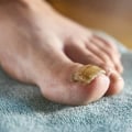 Can you remove toenail fungus yourself?