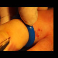 Understanding Nail Avulsion with Phenolization Treatment