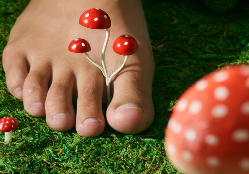 Acupuncture for Toenail Fungus: A Natural Treatment Option