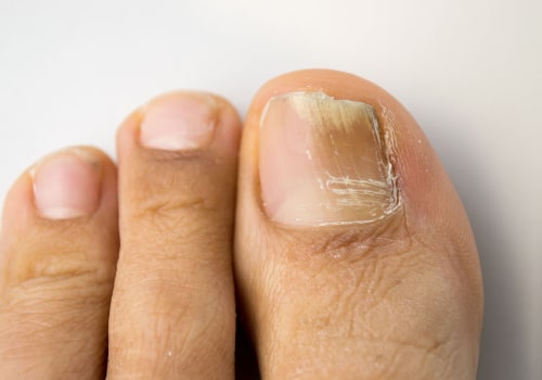Understanding Laser Treatment for Toenail Fungus