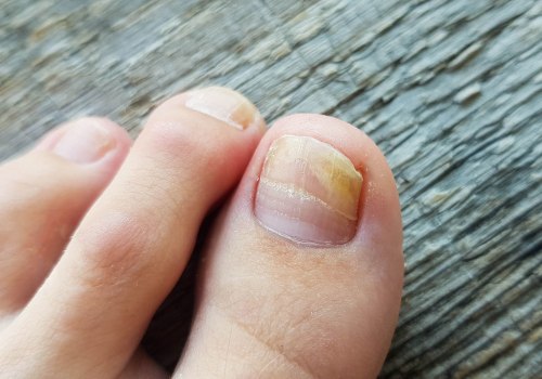 Oral Antifungal Medications for Toenail Fungus: What You Need to Know