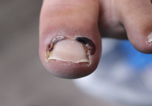 What worsens toenail fungus?