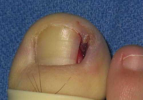Nail Avulsion with Matrixectomy Treatment: Understanding Toenail Fungus Solutions