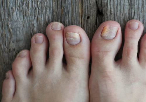 Top 10 Tips for Healthy Feet: Preventing Toenail Fungus