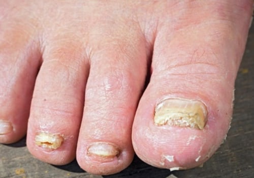 Unlock the Power of Oregano Oil for Toenail Fungus Cure