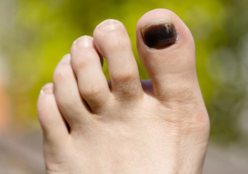 Darkening of the Toenail: Causes, Treatments, and Prevention