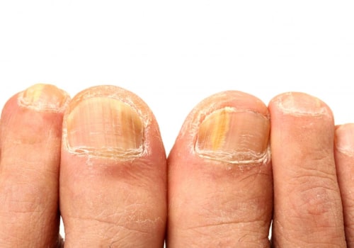Understanding Yeast Infection and Its Effects on Toenails