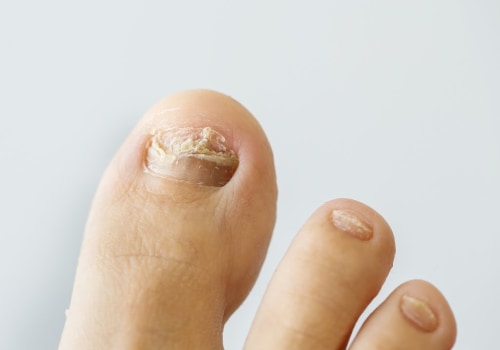 Does hydrogen peroxide help toenail fungus?