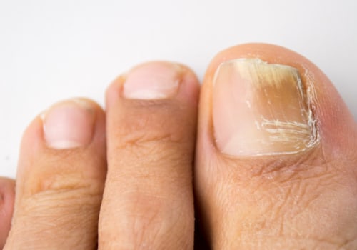 What gut bacteria causes toenail fungus?