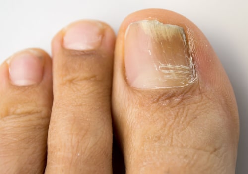 Understanding Contact with Infected Persons: How to Prevent and Treat Toenail Fungus