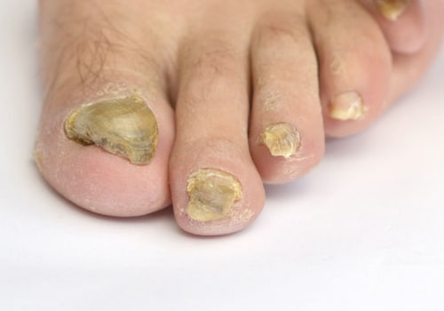 What is the most powerful toenail fungus treatment?