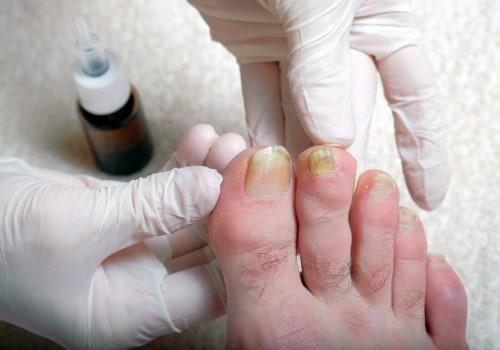 Understanding Yellowing of the Toenail