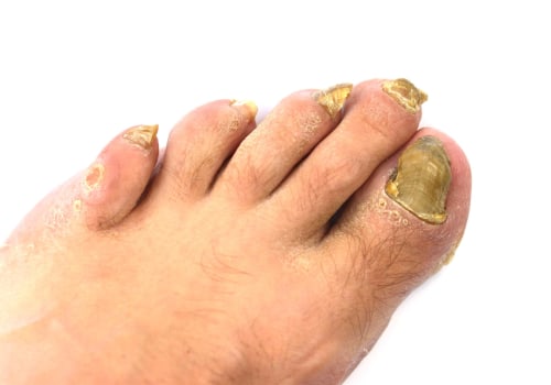 Will coconut oil cure toenail fungus?
