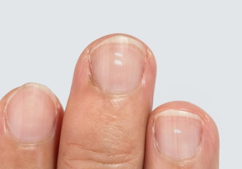 White or Yellow Patches Underneath the Nail: Causes, Treatments, and Prevention Tips