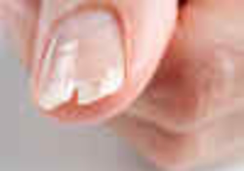 Understanding Brittle and Crumbly Nails: Causes, Treatments, and Prevention Tips