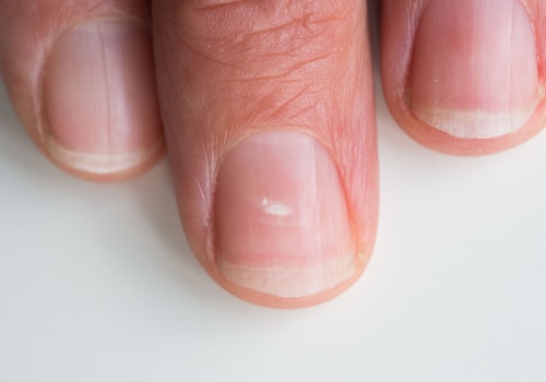 Understanding Loosening and Separation of the Nail from the Nail Bed