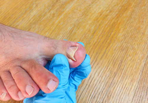 The Importance of Keeping Your Feet Dry and Clean for Preventing and Treating Toenail Fungus