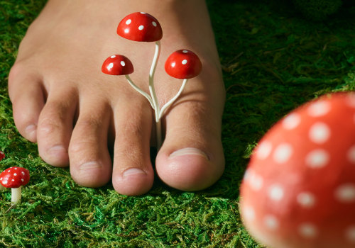 10 Vitamin C and Zinc rich foods to help prevent toenail fungus