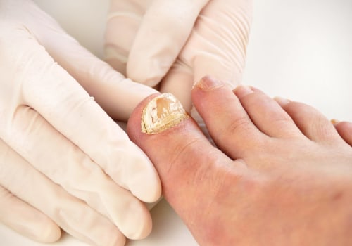 How do you test for toenail fungus?