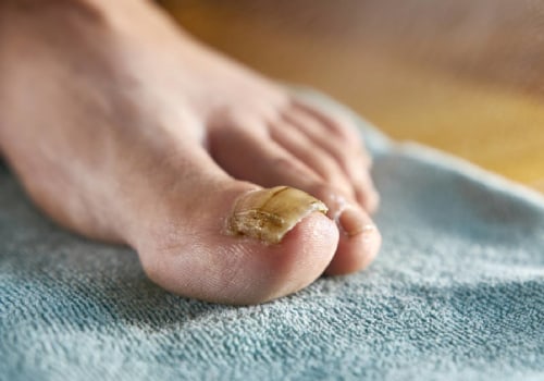 Can you remove toenail fungus yourself?