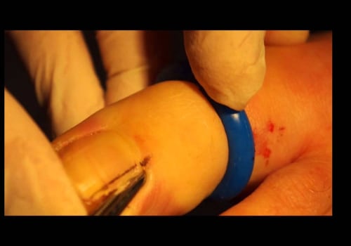 Understanding Nail Avulsion with Phenolization Treatment