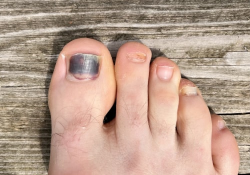 10 Tips for Managing Stress Levels and Preventing Toenail Fungus