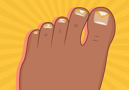 Understanding Moisture and Humidity: The Hidden Causes of Toenail Fungus